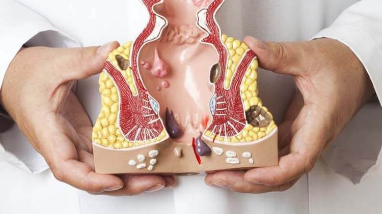 Jual Obat Wasir Ambeien De Nature Di Jember